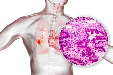 Adenocarcinoma