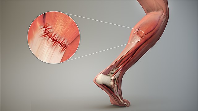 Espasmo muscularEspasmo muscular