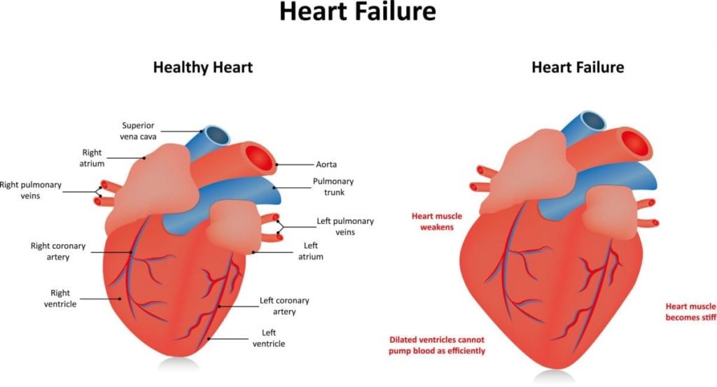 Insuficiência cardíaca