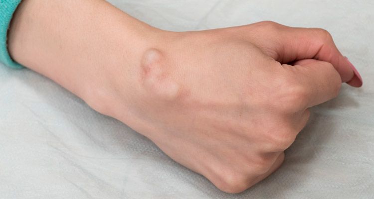 O que é um lipoma