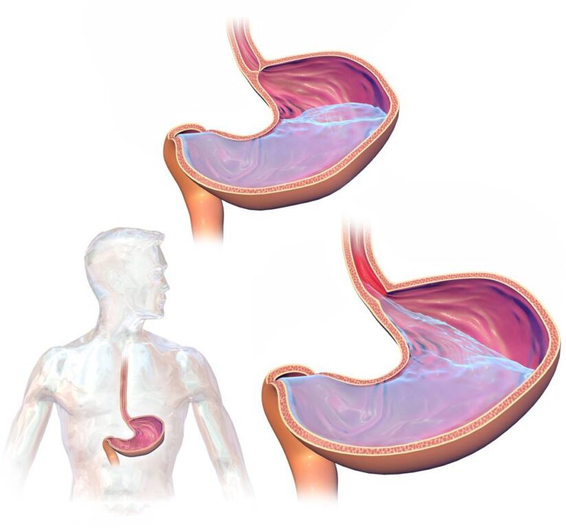 Refluxo gastroesofágico
