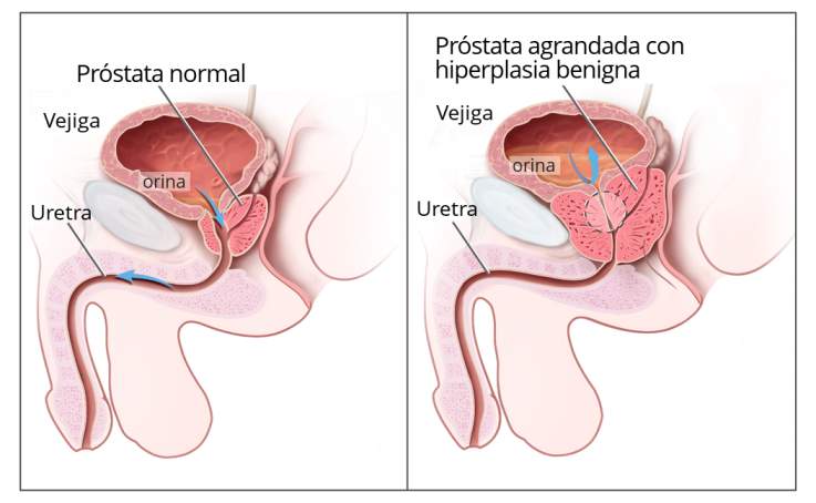 prostata